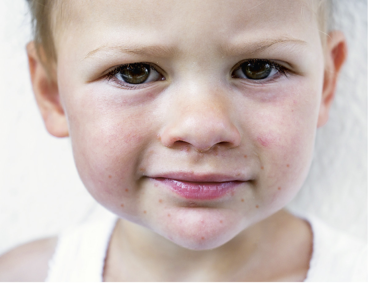 Kind_mit_Ausschlag_im_Gesicht